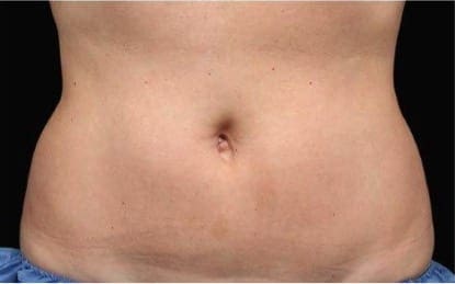 CoolSculpting After