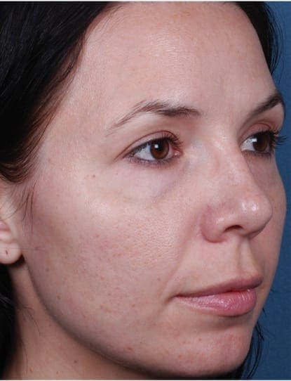 skin peel ascot