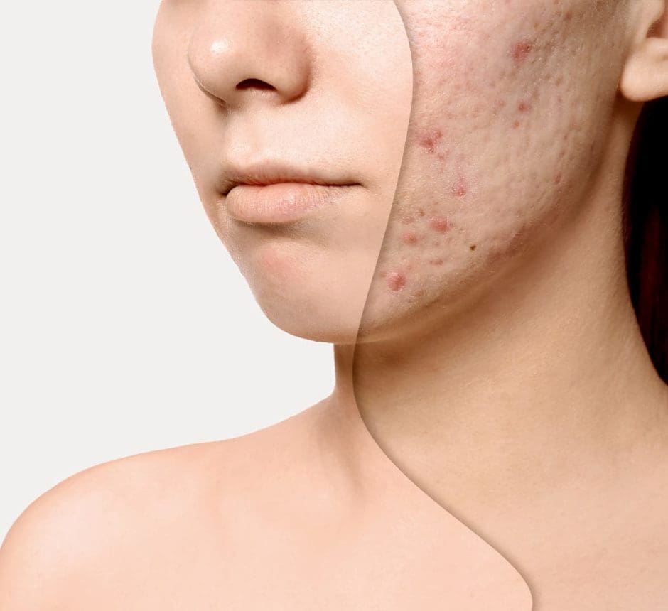 Acne scar treatment london