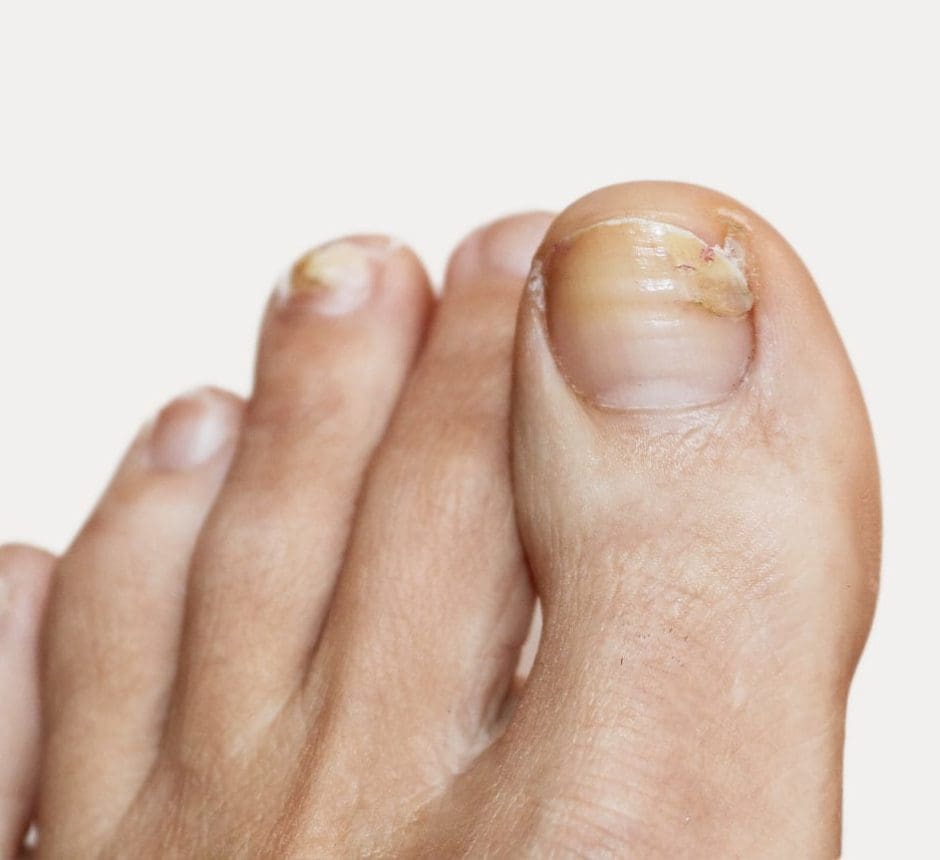 Fungal Nail Treatment