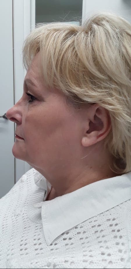 Double Chin Treatment Ascot