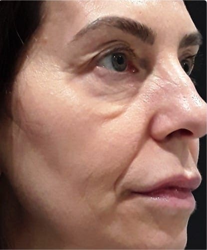 Microneedling After