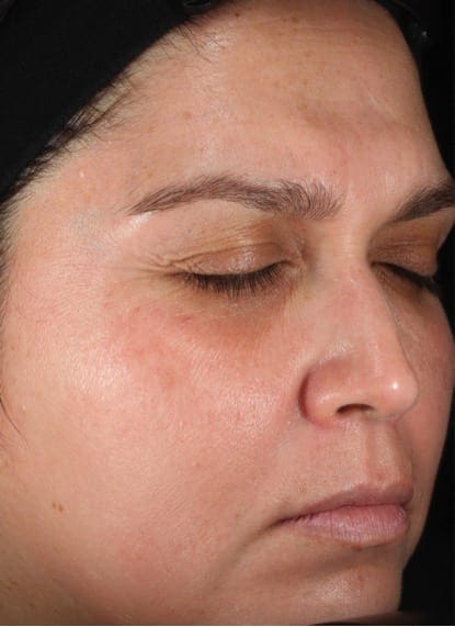 Obagi Nu-Derm® After