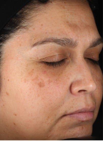 Obagi Nu-Derm® Before